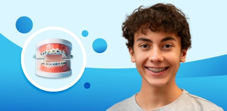 Braces Treatment 