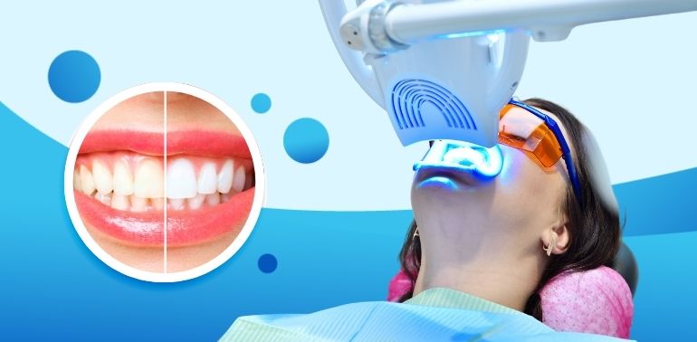 Teeth Whitening