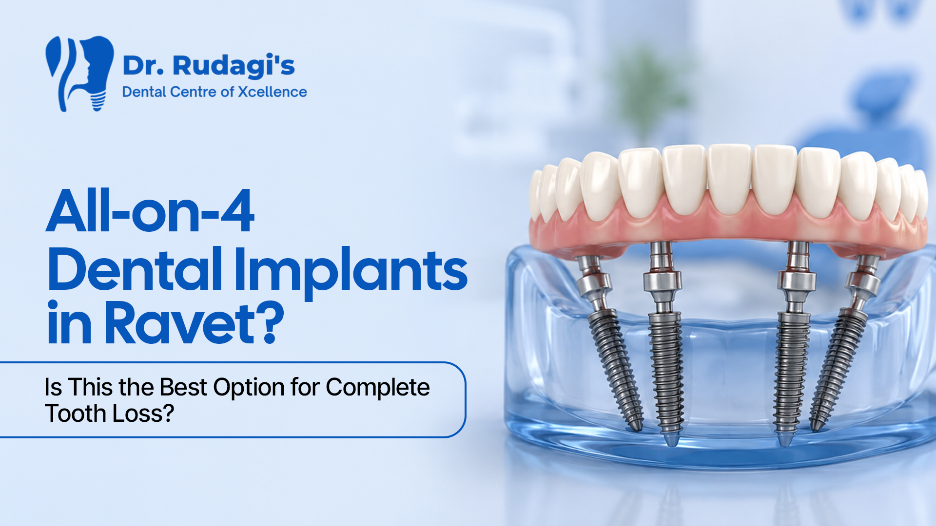 All-on-4 Dental Implants in Ravet – Is This the Best Option for Complete Tooth Loss?