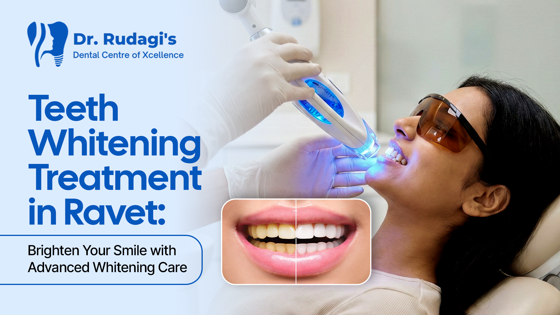 Teeth Whitening Treatment in Ravet - Brighten Your Smile with Advanced Whitening Care